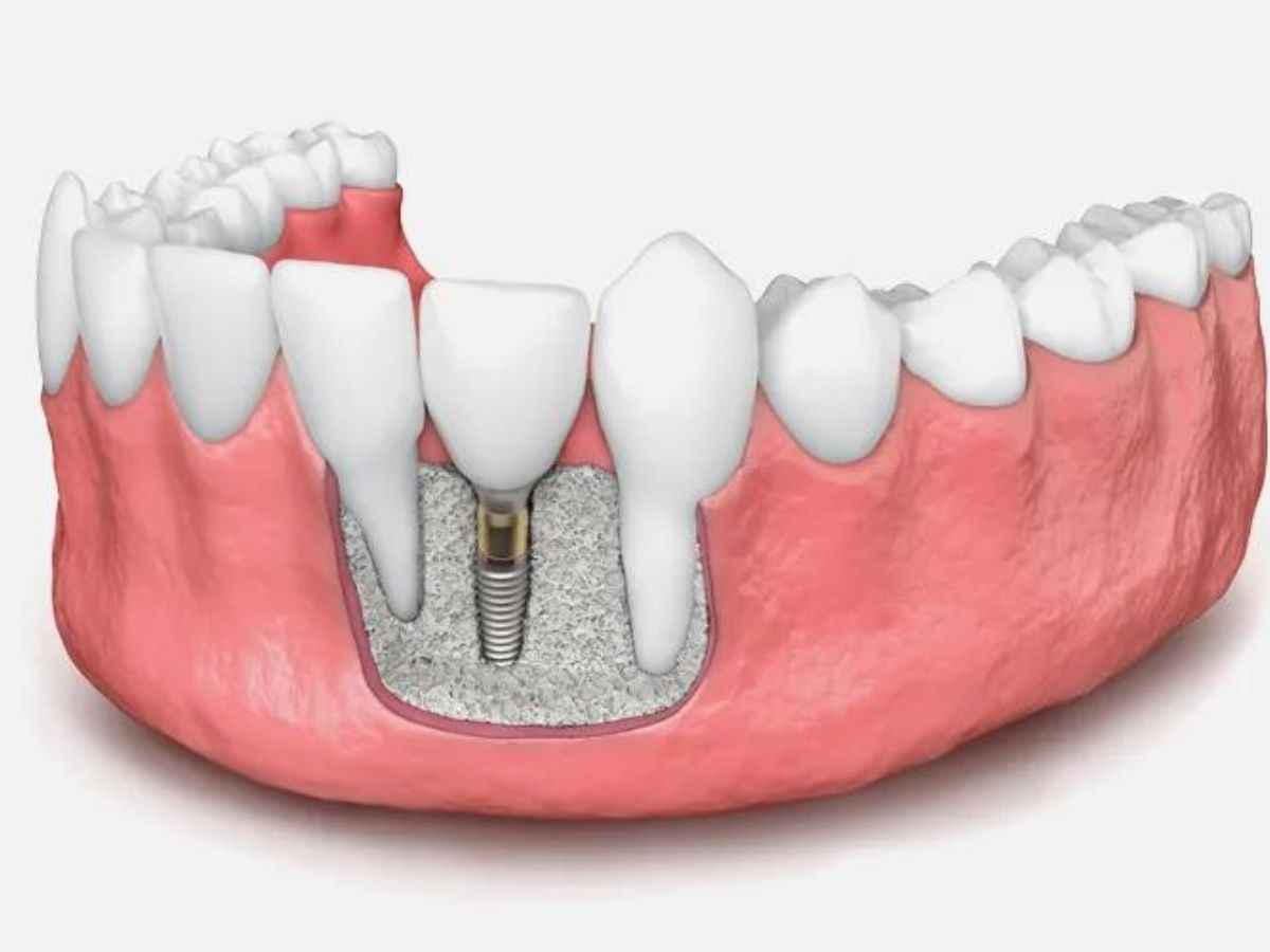 A dental implant featuring a tooth, illustrating the integration of a bone graft for enhanced stability and support.